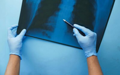 Homeopathic Support for Respiratory Issues in Lung Cancer Patients