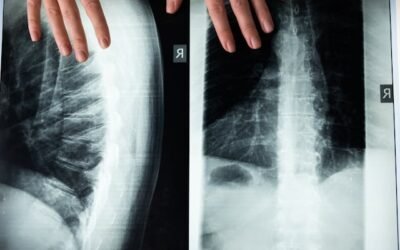 Homeopathy for Enhancing Bone Health After Cancer Treatments